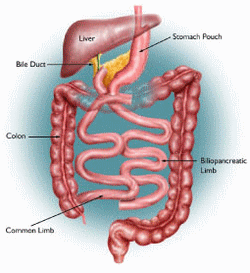 duodenal switch