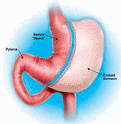 gastric sleeve